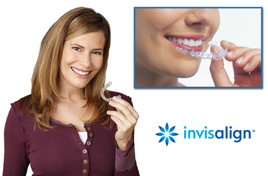 Invisalign_Info
