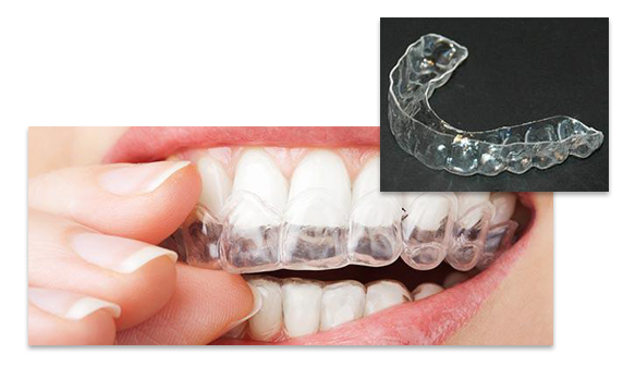 Retainer_Instructions